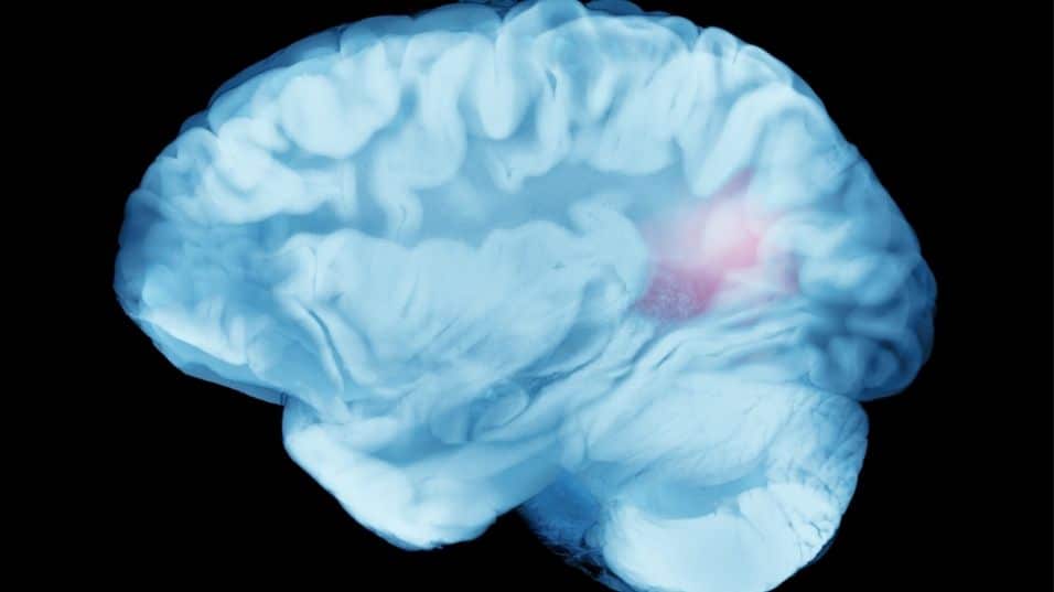 โรคหลอดเลือดสมอง Hemorrhagic Stroke