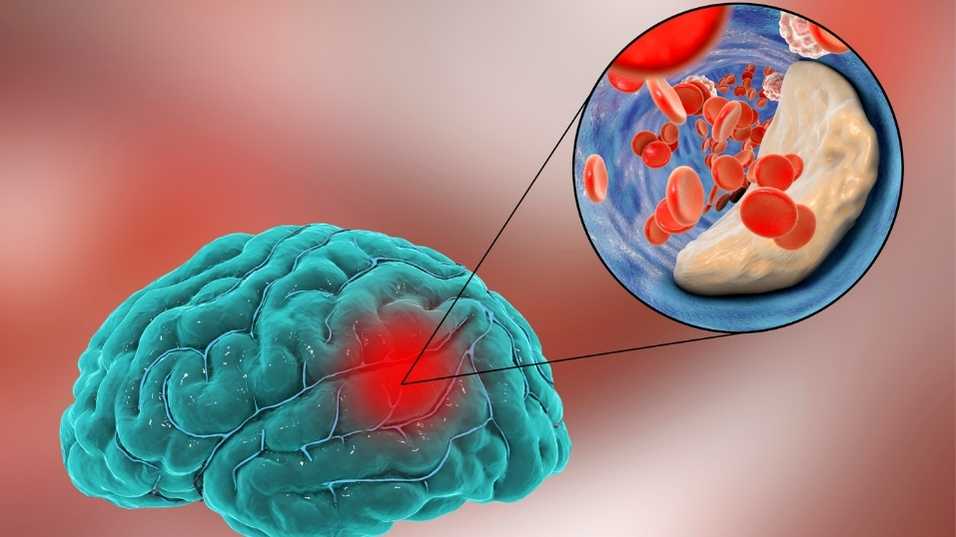 โรคหลอดเลือดสมอง Ischemic Stroke