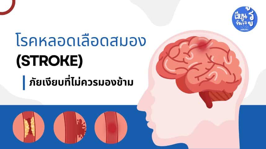 โรคหลอดเลือดสมอง Stroke